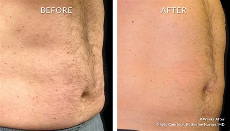 Bodysculpt Hawaii Specializing in Emsculpt and Coolsculpting in .
